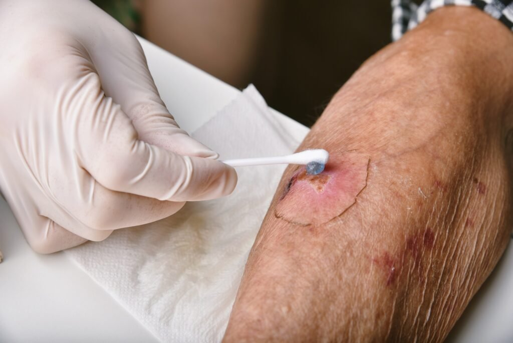 Wound dressing